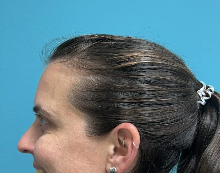 After Image: Neurotoxin - left-side