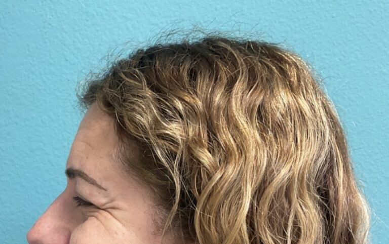 Before Image: Neurotoxin - left-side
