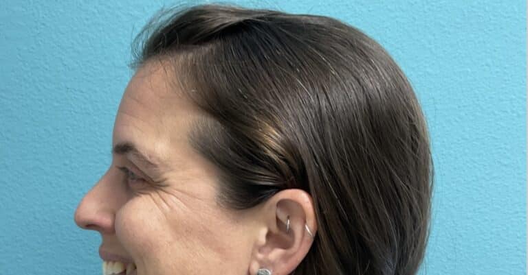 Before Image: Neurotoxin - left-side