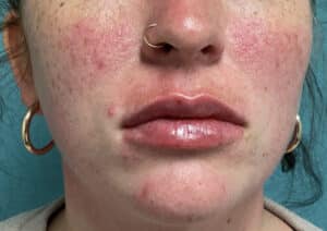 After Image: Lip Filler