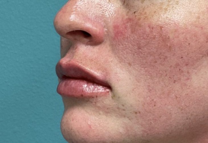 After Image: Lip Filler - left-side