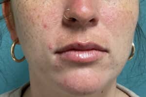 Before Image: Lip Filler