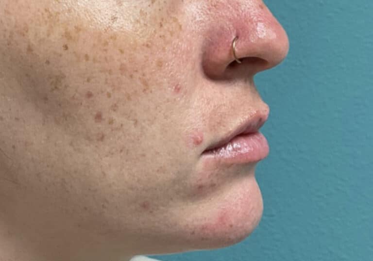 Before Image: Lip Filler - right-side