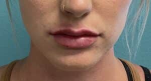 After Image: Lip Filler
