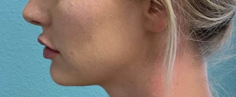 After Image: Lip Filler - left-side
