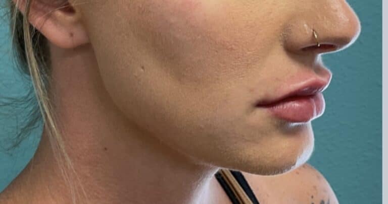 After Image: Lip Filler - right-side