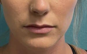Before Image: Lip Filler