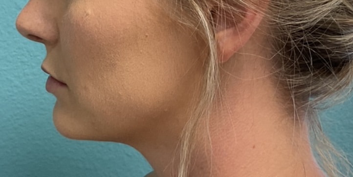 Before Image: Lip Filler - left-side