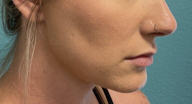 Before Image: Lip Filler - right-side