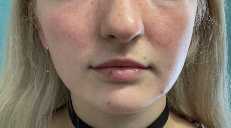 After Image: Lip Filler - front