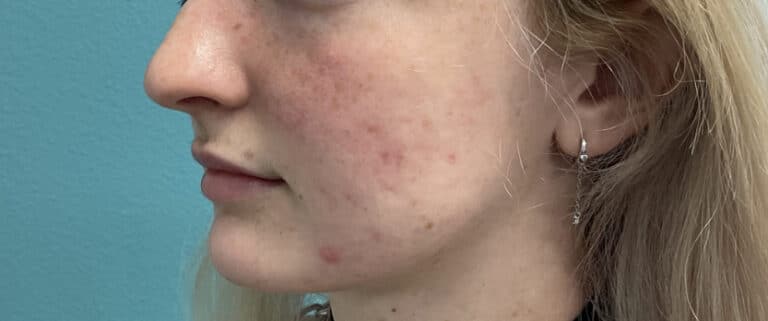 After Image: Lip Filler - left-front-oblique