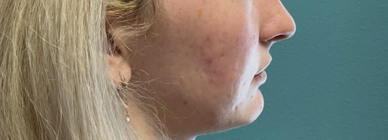 After Image: Lip Filler - right-side