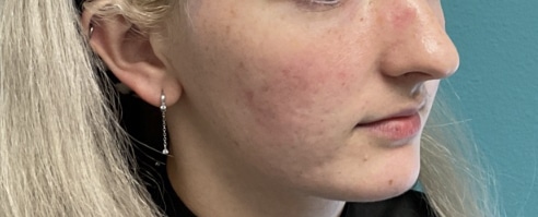 Before Image: Lip Filler - right-front-oblique