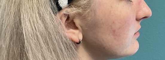 Before Image: Lip Filler - right-side