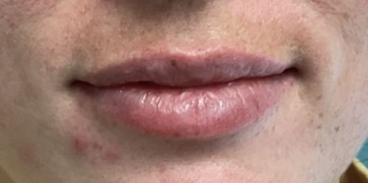 After Image: Lip Filler - front