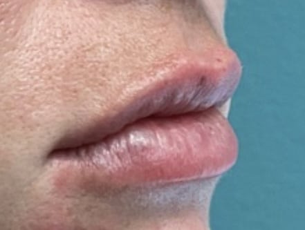 After Image: Lip Filler - right-side