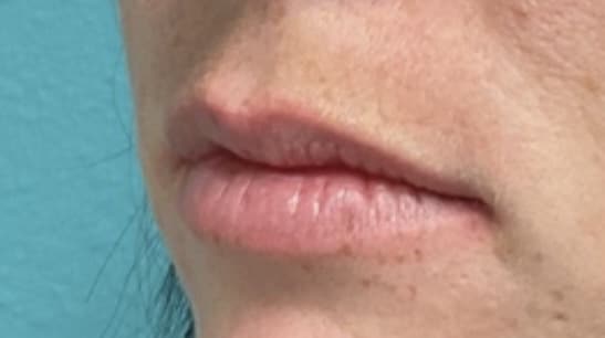 Before Image: Lip Filler - left-side