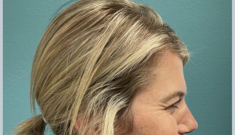 Before Image: Neurotoxin - right-side