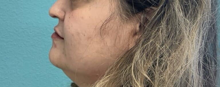 After Image: Lip Filler - left-side