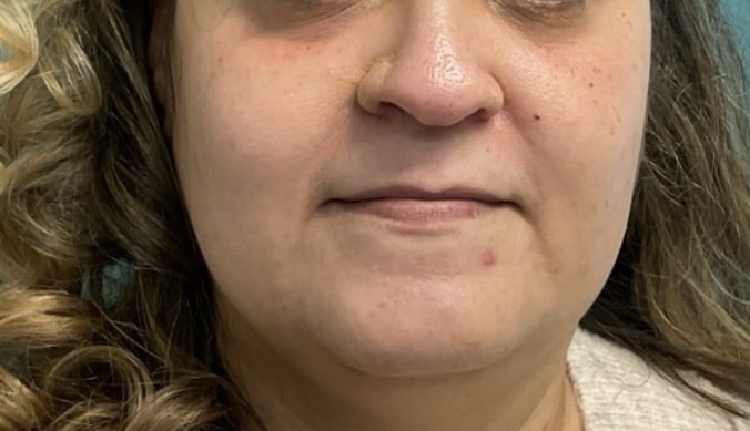 Before Image: Lip Filler - front