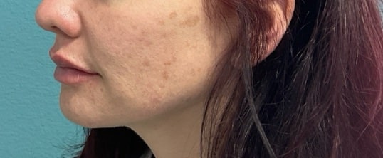After Image: Lip Filler - left-front-oblique