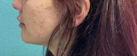 After Image: Lip Filler - left-side