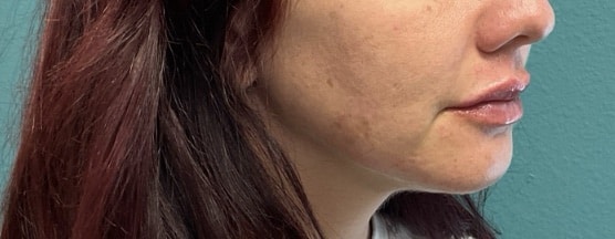 After Image: Lip Filler - right-front-oblique