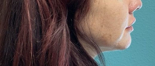 After Image: Lip Filler - right-side