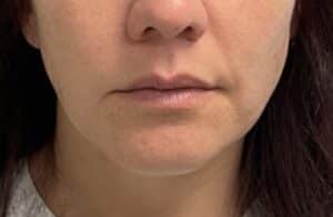 Before Image: Lip Filler