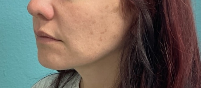 Before Image: Lip Filler - left-front-oblique