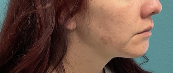 Before Image: Lip Filler - right-front-oblique