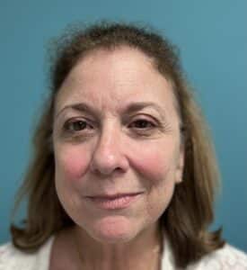 Before Image: Laser Skin Resurfacing / Tightening