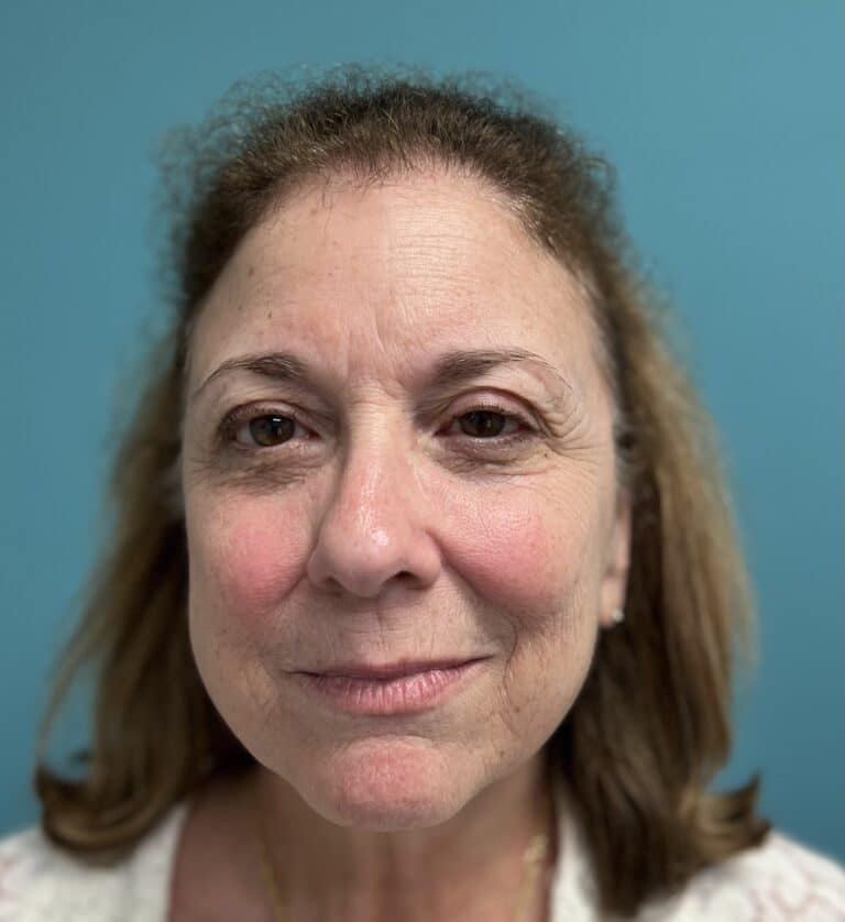Before Image: Laser Skin Resurfacing / Tightening - front