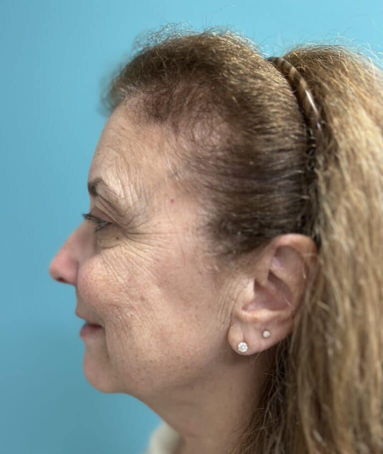 Before Image: Laser Skin Resurfacing / Tightening - left-side
