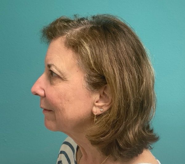 After Image: Laser Skin Resurfacing / Tightening - left-side