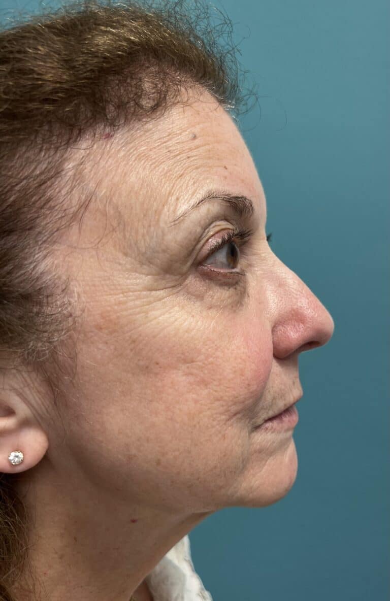 Before Image: Laser Skin Resurfacing / Tightening - right-side