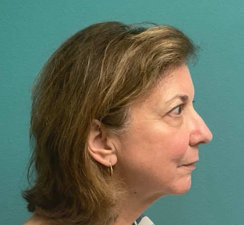 After Image: Laser Skin Resurfacing / Tightening - right-side